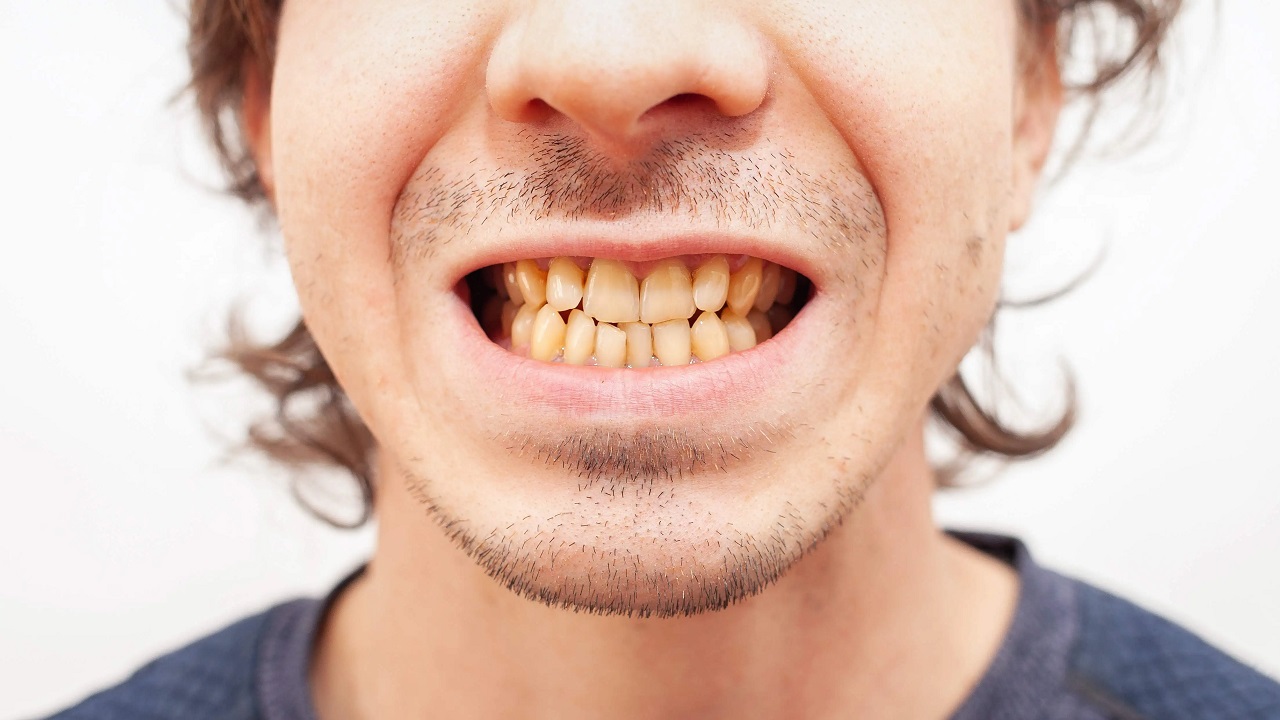 The Essential Guide to Coconut Oil Teeth Whitening Strips Factory